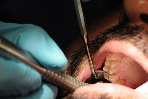 NHS patients have thousands of fillings removed after falling ill