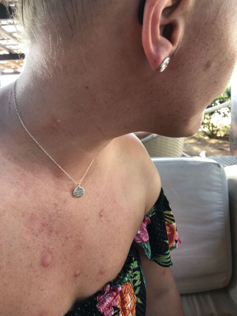 TUI Holidaymaker "slept fully clothed after being eaten alive by bed bugs" during £3k, 5 star break