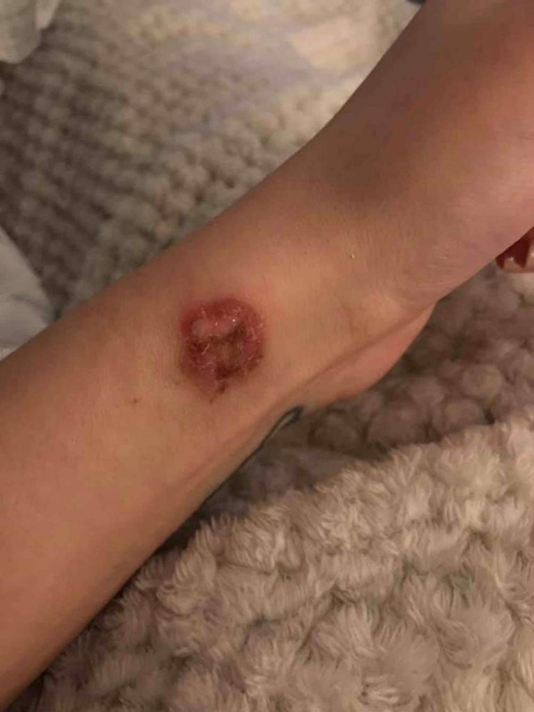 ASDA customer posts gruesome images of burns she claims were caused by "faulty hot water bottle"