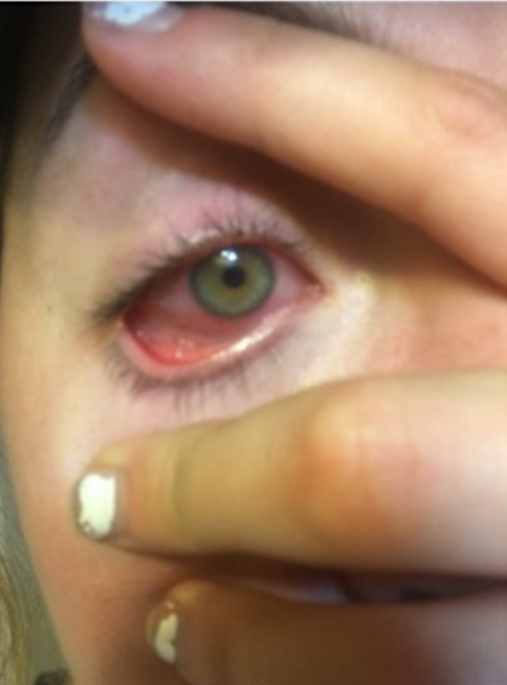 Red eyeball