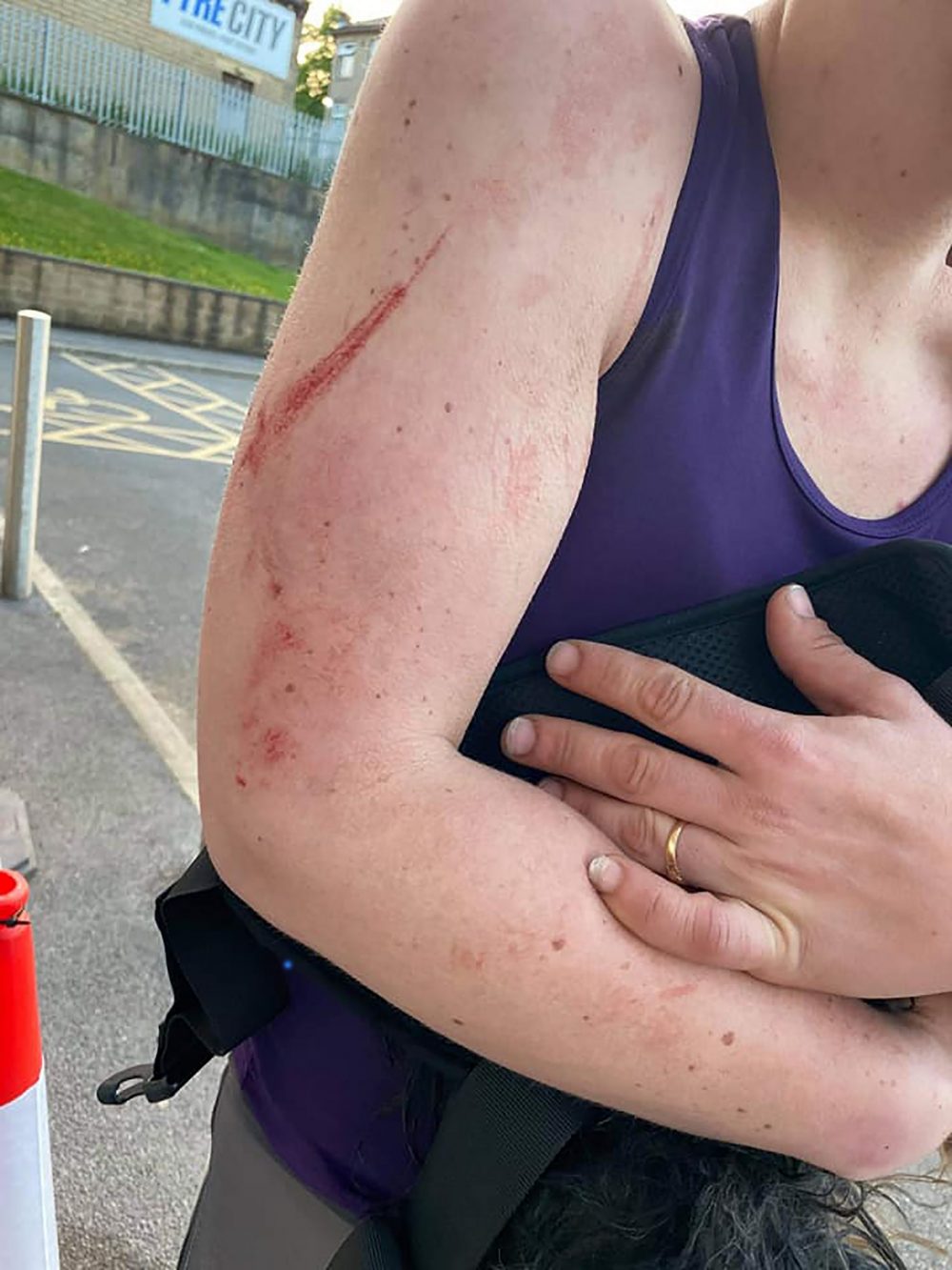 The scratches Marie got from the Mastiff's while trying to save her dog - Animal News UK