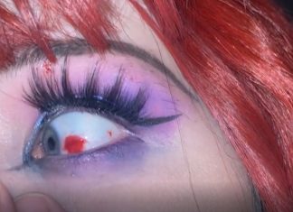 Abbey's eye with burst blood vessel.