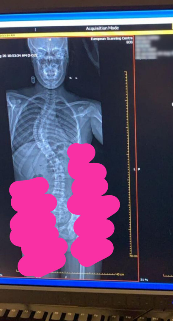 Kaitlans spine before the operation