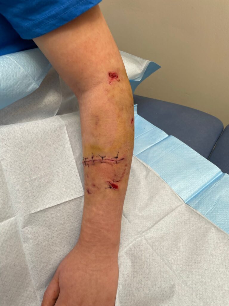 The victim's arm following the dog attack.