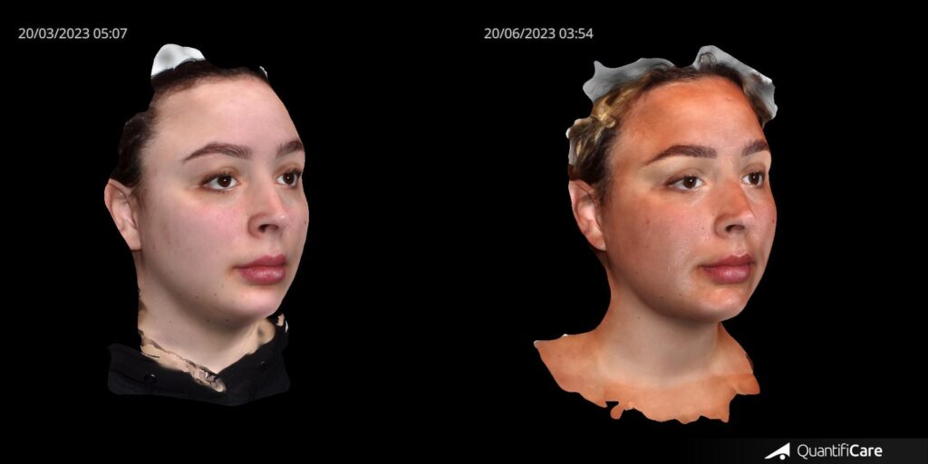 Two pictures of Lucy Geddie before and after her FaceTite Technology treatment